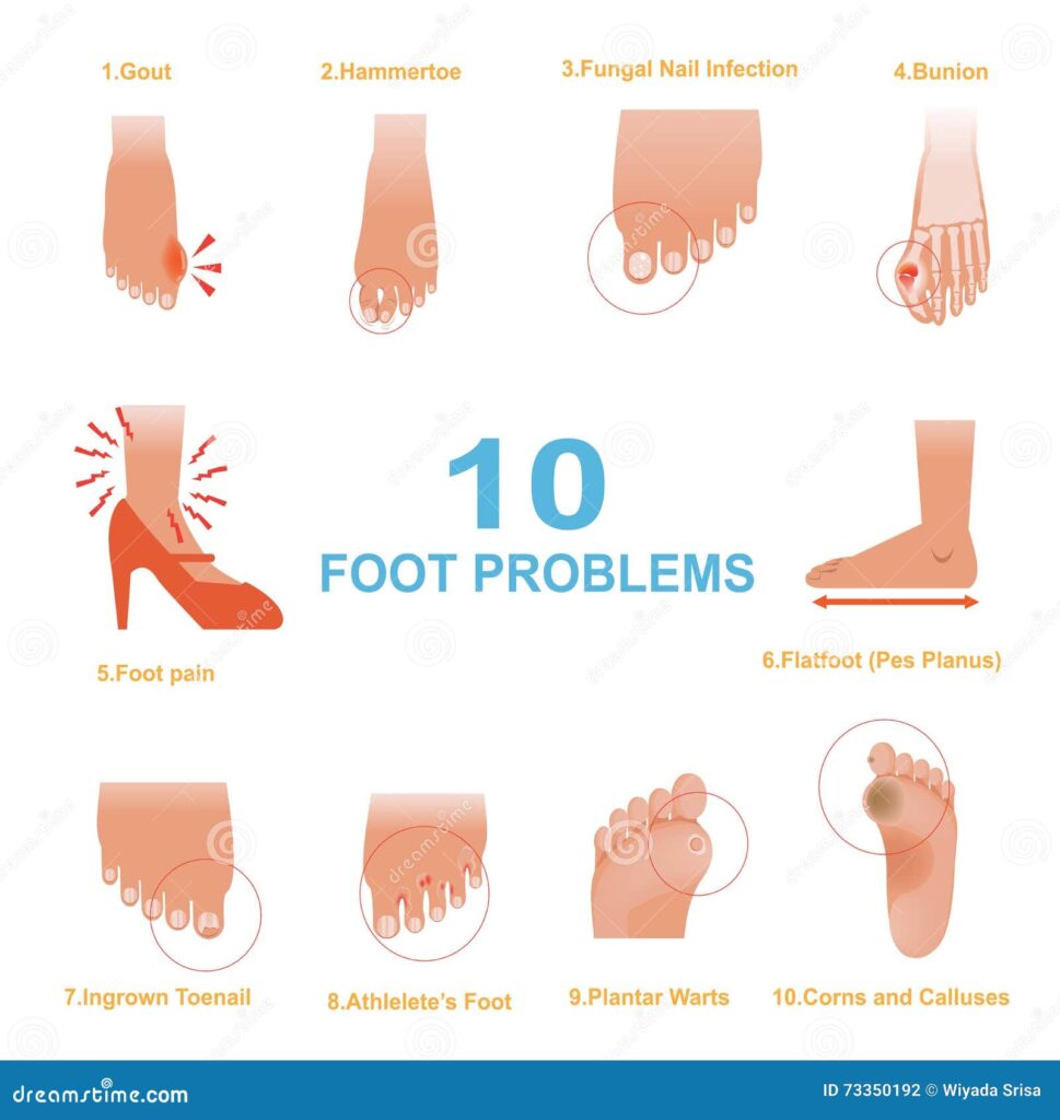 voetproblemen-kinderen